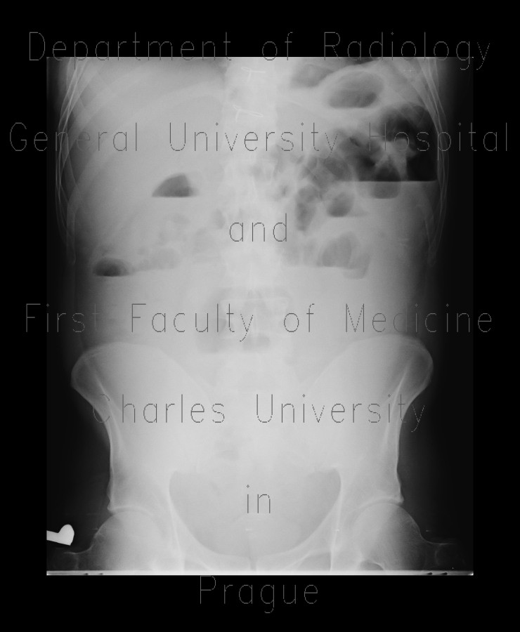 Crohn's disease, rupture of ileum, peritonitis