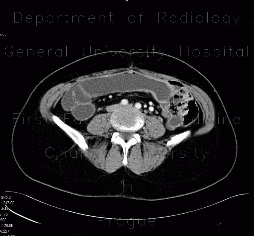 Crohn's disease, subtotal colectomy, ileosigmoid anastomosis