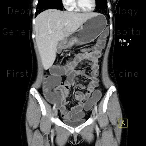 Crohn's disease, terminal ileum, enterography