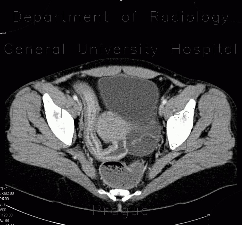 Crohn's disease, terminal ileum, stenosis, CT enterography