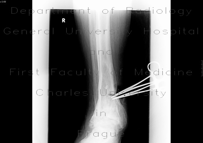 Cut wound of tibia, friction saw