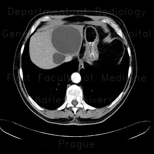 Cyst in liver, simple cyst, large