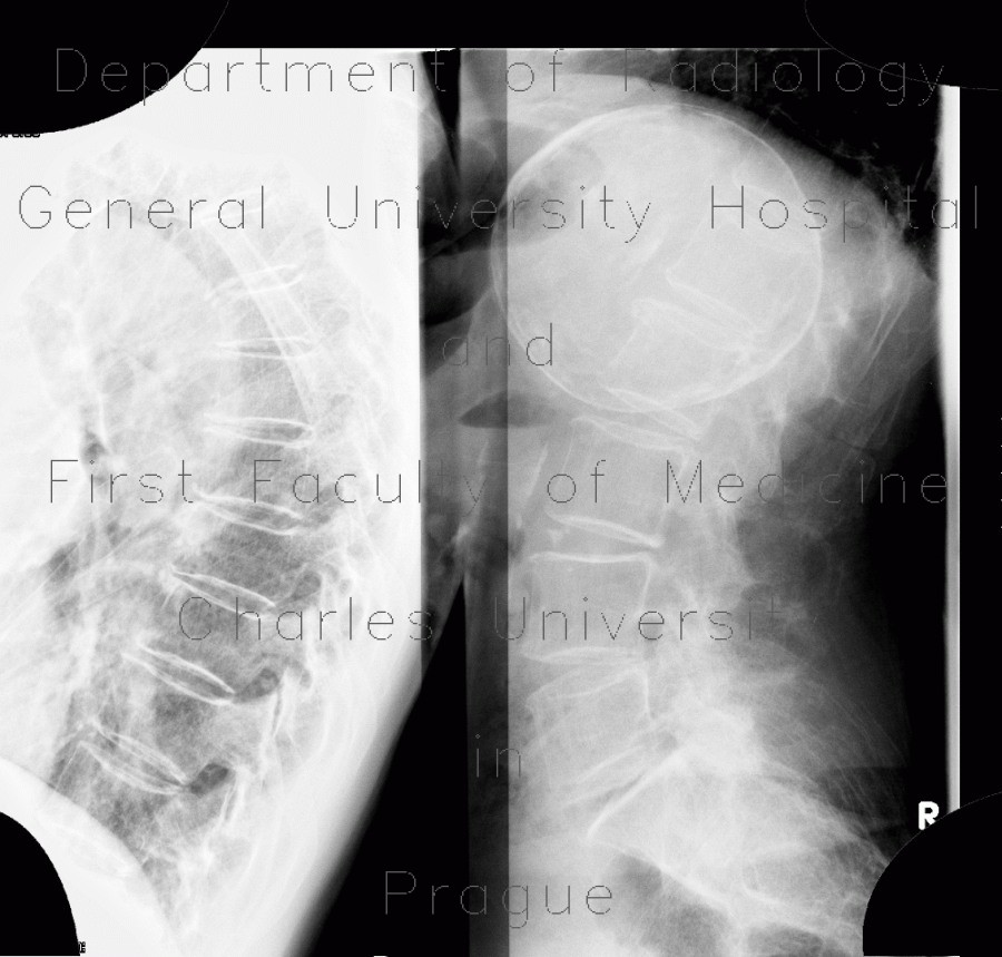 Cyst of a spleen, splenic cyst, calcified