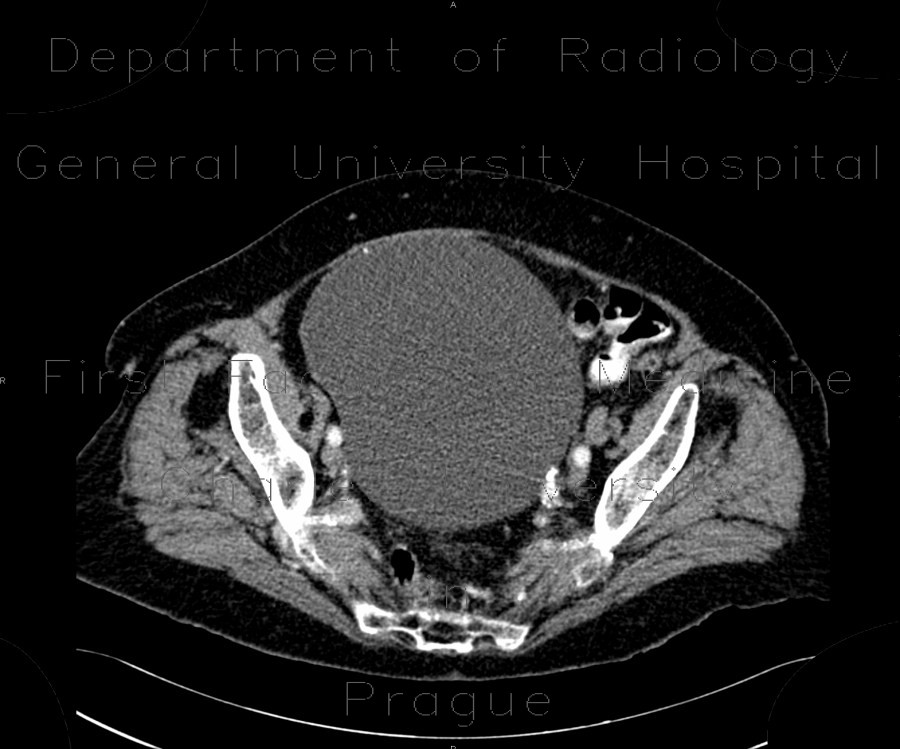 Radiology image - Cyst of ovary, gigantic: Abdomen, Gynecology: CT - Computed tomography
