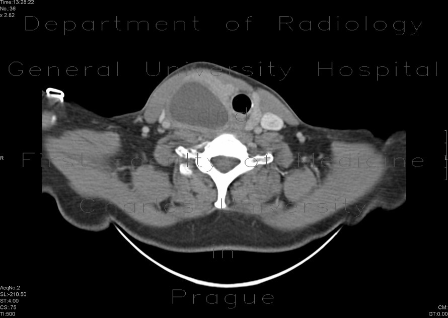 Cyst of the thyroid gland