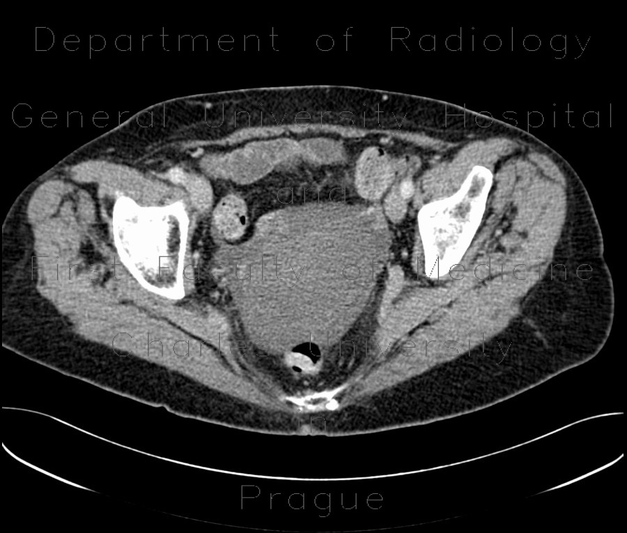 Radiology image - Cystadenoma of ovary: Abdomen, Gynecology: CT - Computed tomography