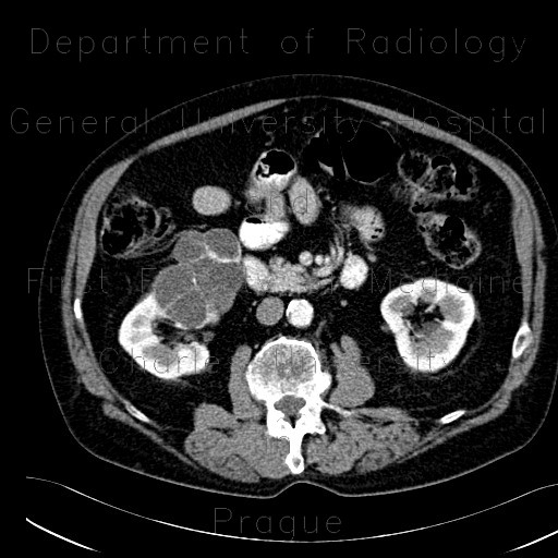 Radiology image - Cystadenoma of the kidney, Perlmann