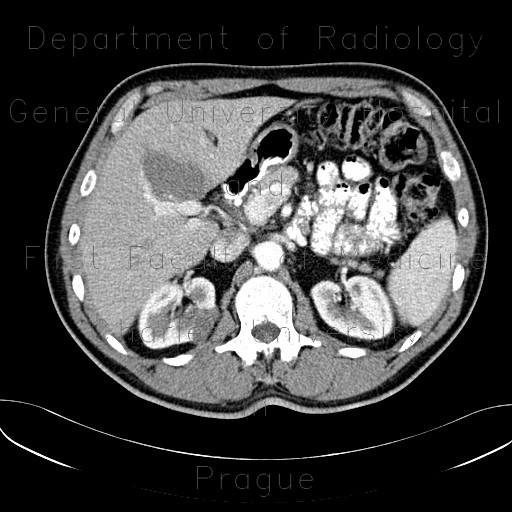 Cystic nephroma, Perlmann's tumour