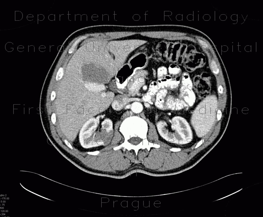 Cystic nephroma, Perlmann's tumour, hemangioma of liver