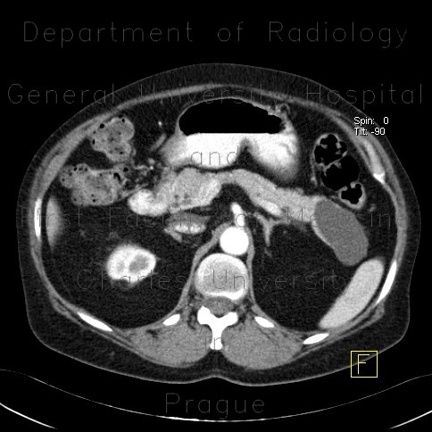 Radiology image - Cystic tumour of pancreas, pancreatic tail: Abdomen, Pancreas: CT - Computed tomography