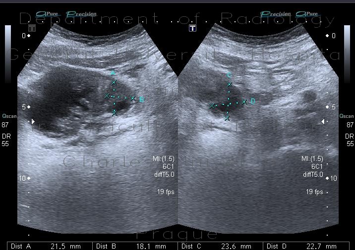 Radiology image - Cystitis, acute cystitis: Abdomen, Urinary tract: US - Ultrasound