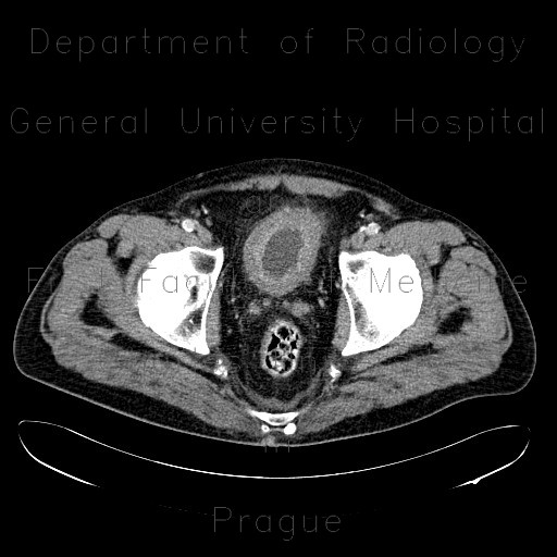 Cystitis, acute cystitis, bladder