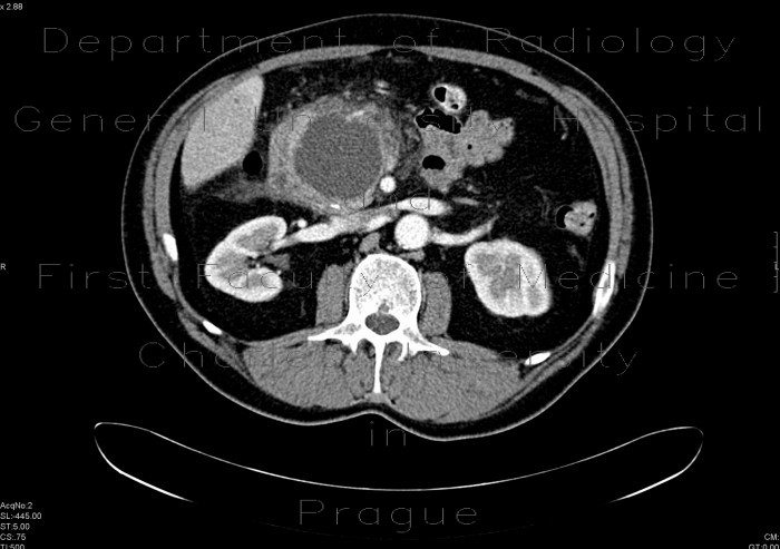 Radiology image - Cystoid of pancreas: Abdomen, Pancreas: CT - Computed tomography