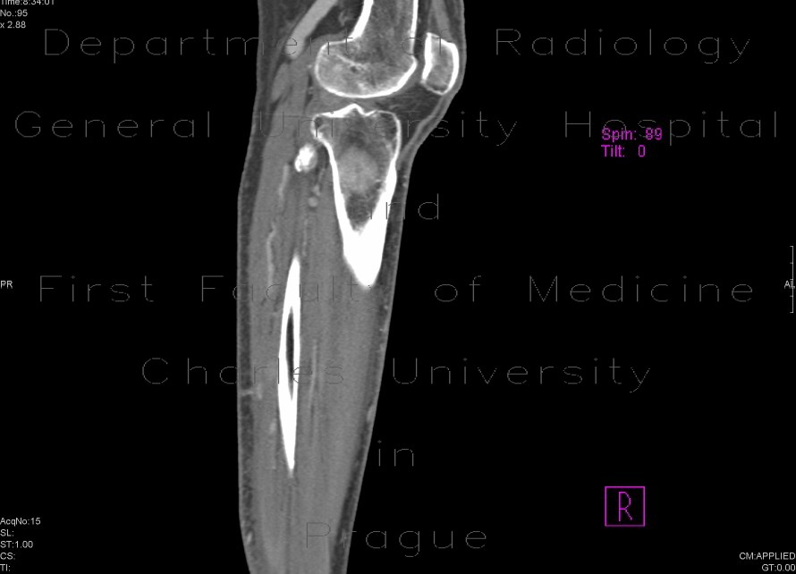 DLBCL of bone and muscle