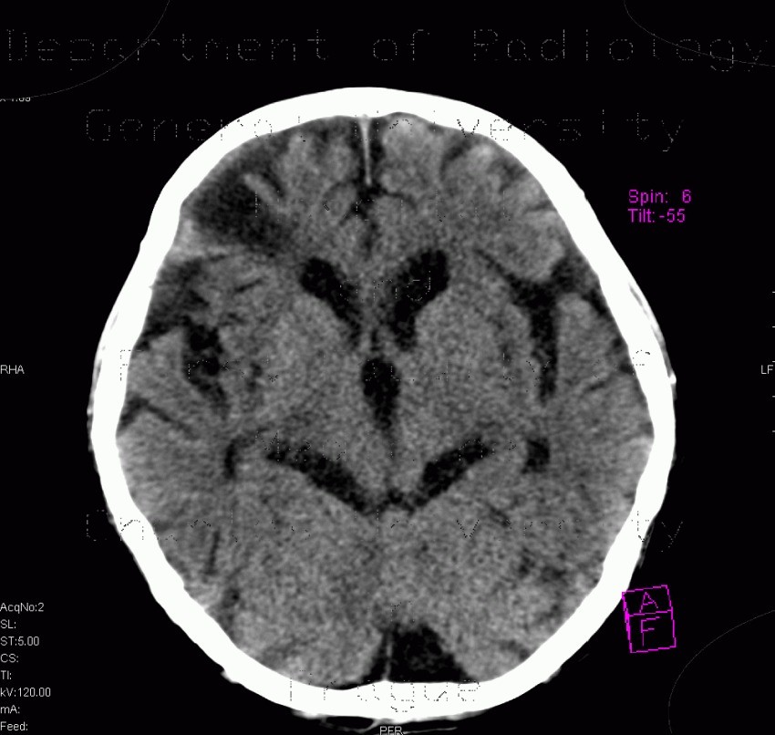Radiology image - Dandy Walker variant, mega cisterna magna: Brain, Brain: CT - Computed tomography