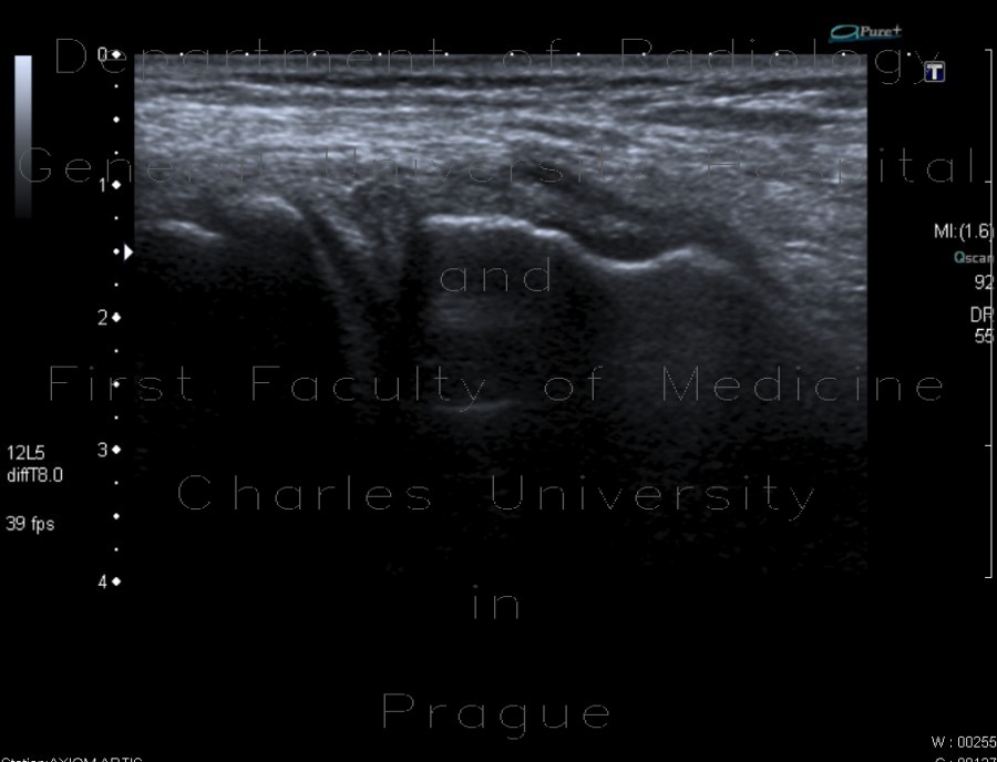 Radiology image - Degeneration of meniscus: Extremity, Soft tissue: US - Ultrasound