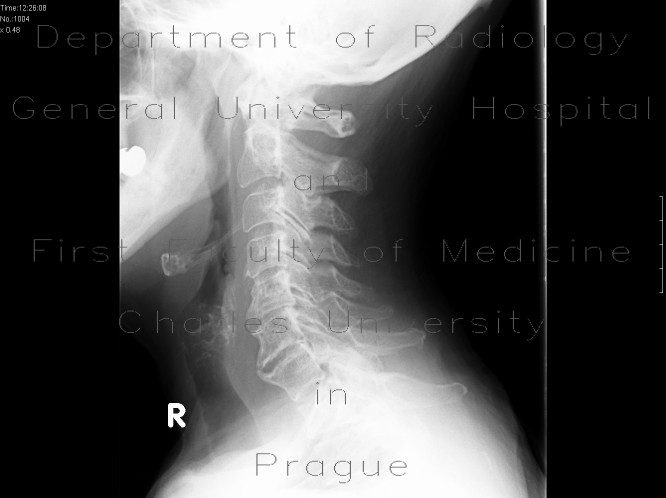 Degenerative changes of the cervical spine