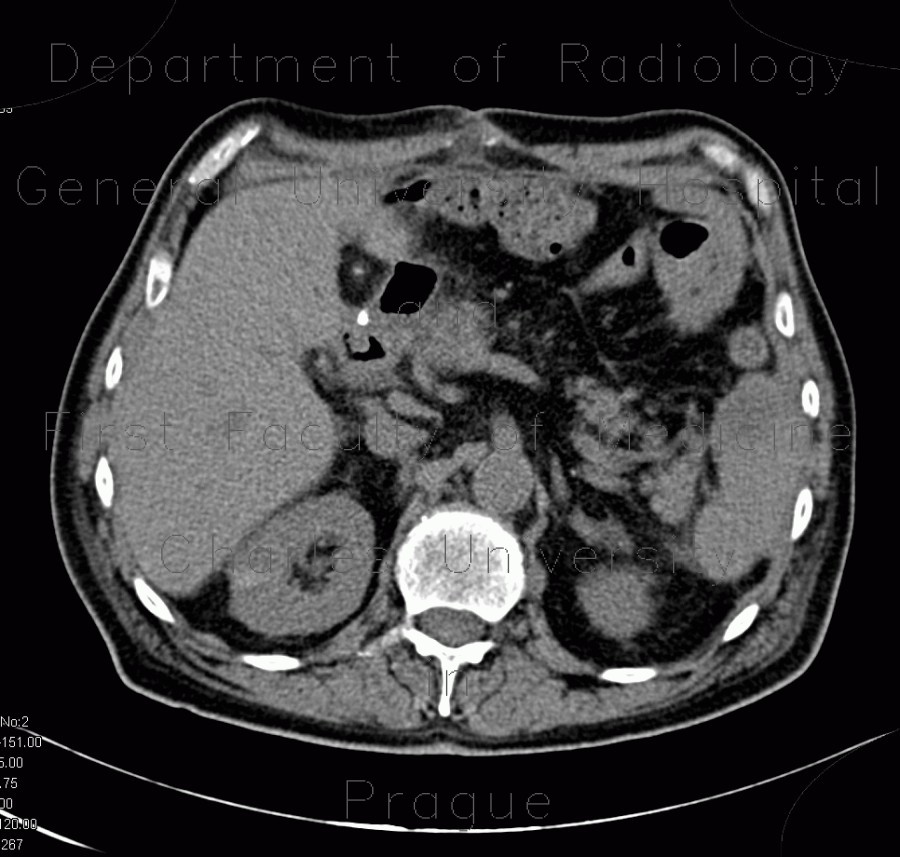 Radiology image - Delayed excretion of contrast from kidney, day four: Abdomen, Kidney and adrenals: CT - Computed tomography