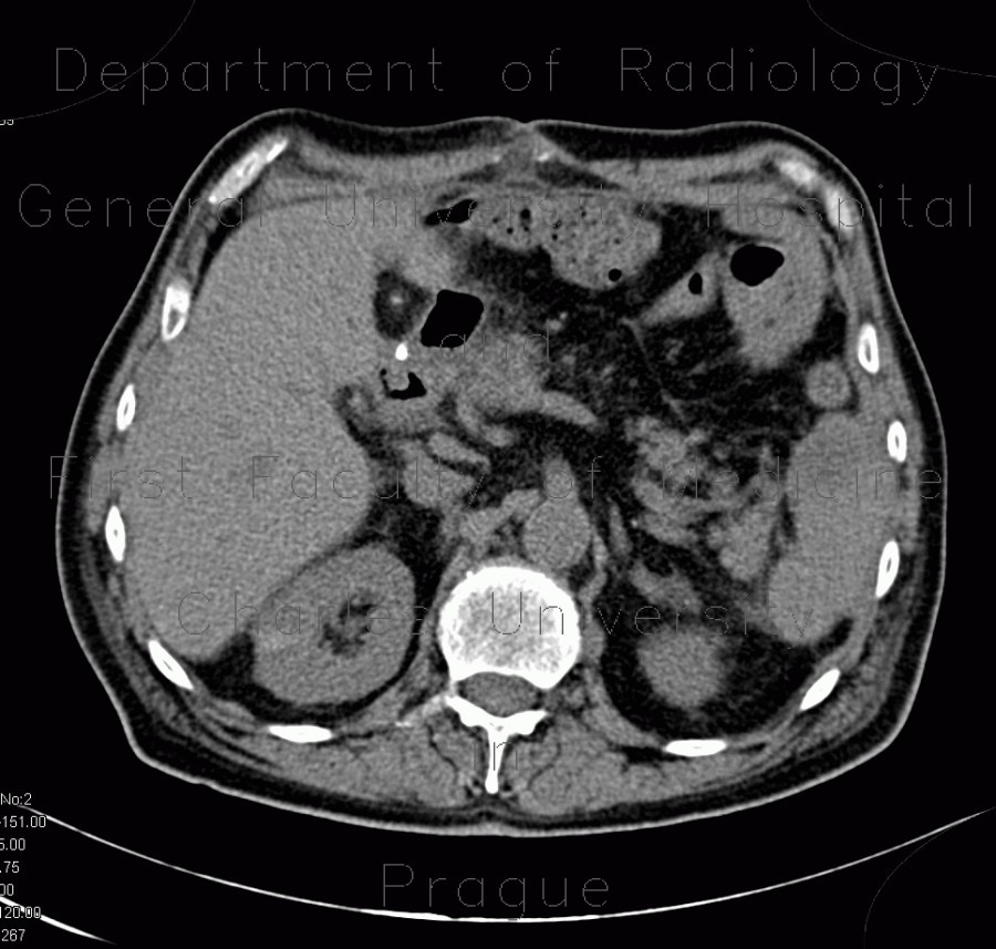 Delayed excretion of contrast from kidney, day four