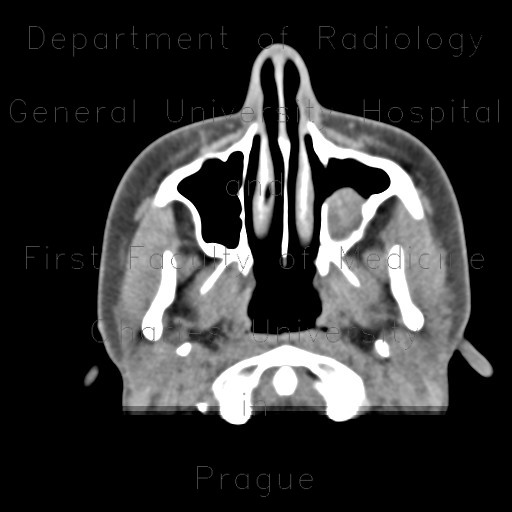 Radiology image - Dentigenous cyst in maxillary sinus: Head and Neck, Oral cavity, Sinuses: CT - Computed tomography