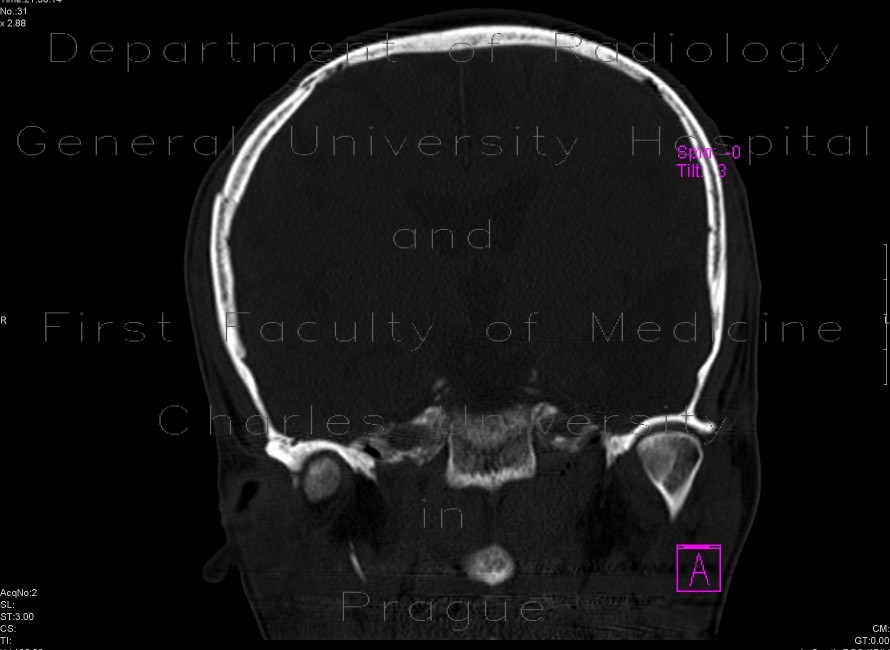 Depression fracture of the skull