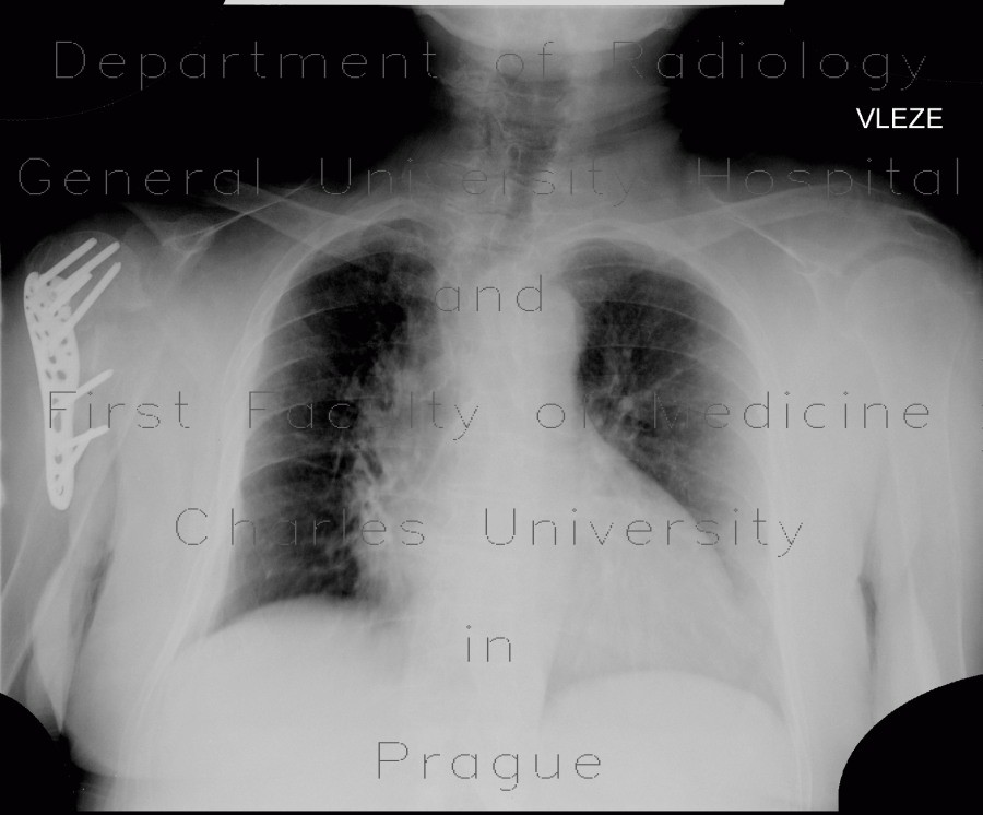 Deviation of trachea