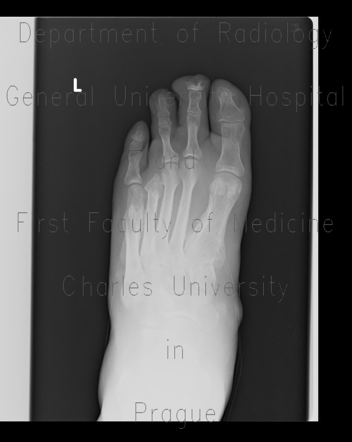 Diabetic foot, amputation of fourth finger, periosteal reaction in metatarsal bone