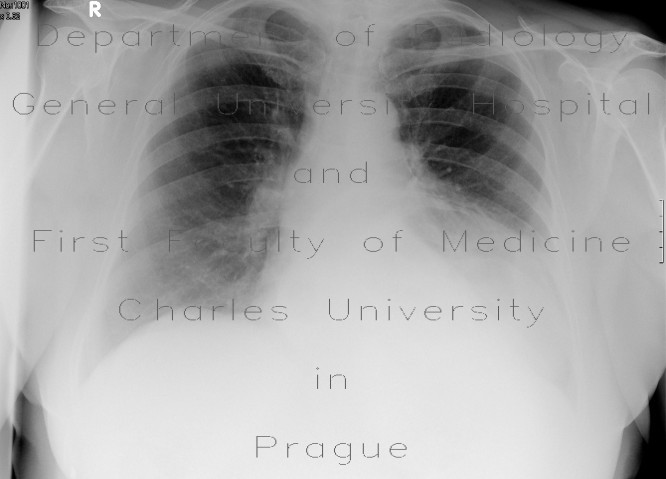 Radiology image - Diaphraghmatic hernia, herniation of lienal flexure and stomach: Abdomen, Thorax, Large bowel, Mediastinum and pleural cavity, Stomach: X-ray - Plain radiograph