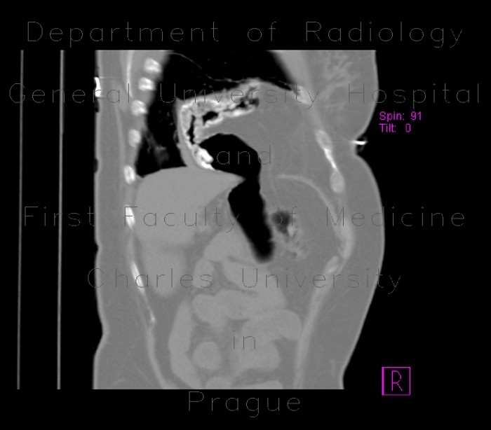 Diaphragmatic hernia, Morgagni hernia