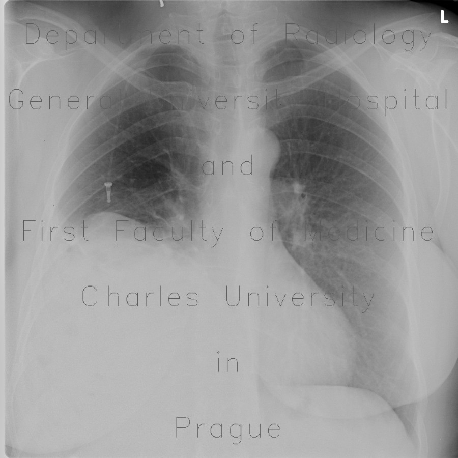 Radiology image - Diaphragmatic hernia, Morgagni hernia: Abdomen, Biliary tree, Large bowel, Liver, Lung, Soft tissue: X-ray - Plain radiograph