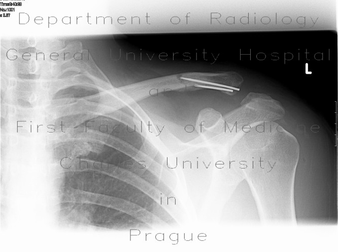 Diastasis in acromioclavicular joint after removal of osteosythetic material