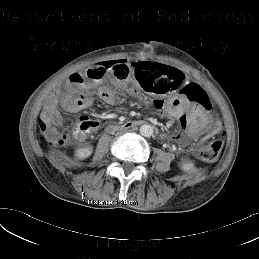 Radiology image - Diffuse peritonitis, dehiscence of rectal anastomosis: Abdomen, Large bowel, Peritoneal cavity: CT - Computed tomography