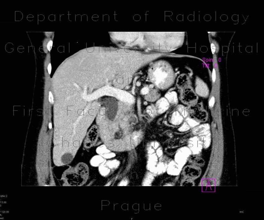 Dilatation of biliary duct, sclerosis of papilla