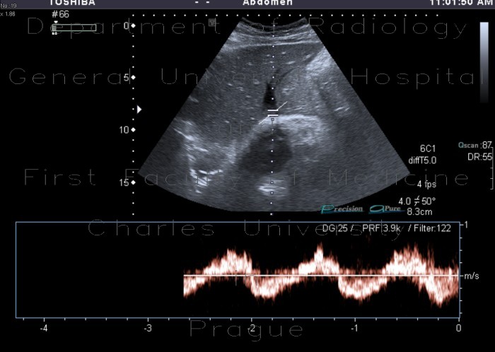 Radiology image - Dilated hepatic veins: Abdomen, Liver, Vessels: US - Ultrasound