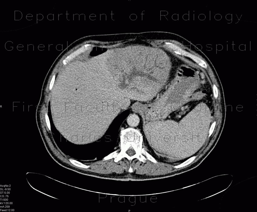 Dilated intrahepatic bile ducts in the left liver lobe, biliodigestive anastomosis, pneumobilia