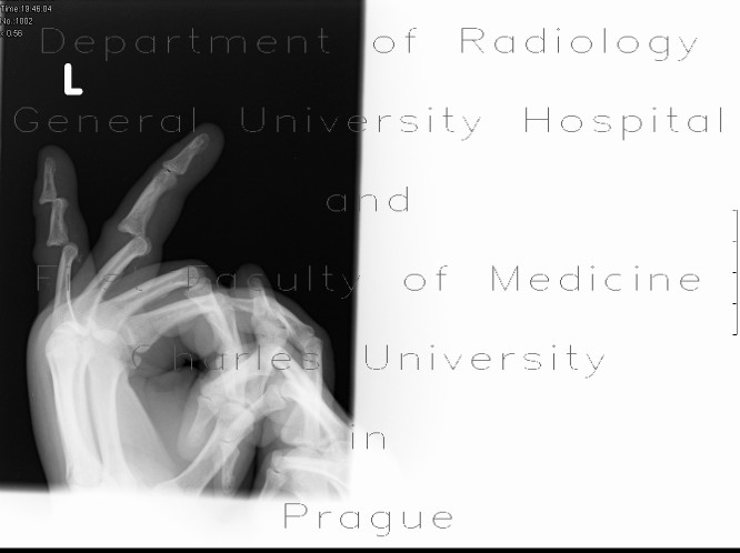 Dislocation of interphalangeal joints