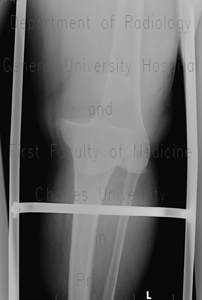 Dislocation of knee joint