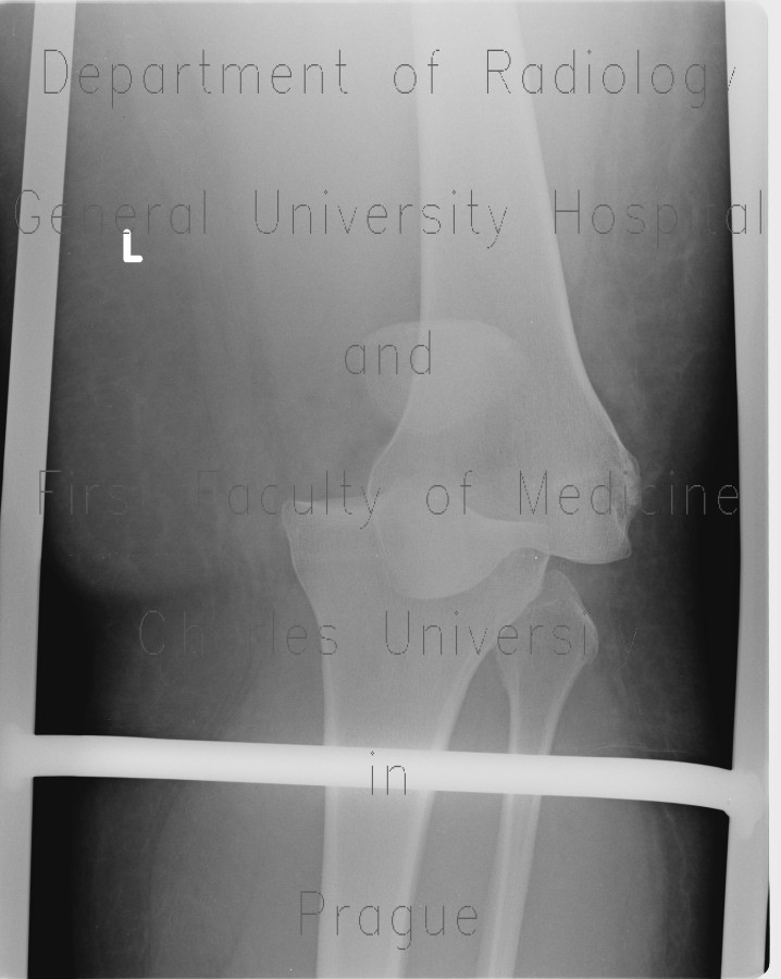 Dislocation of knee joint