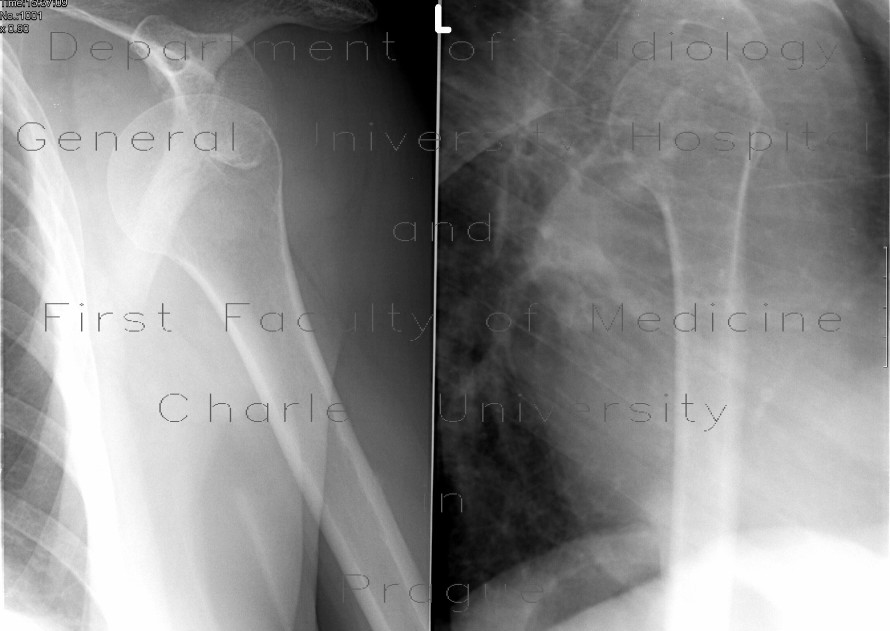 Radiology image - Dislocation of shoulder, anterior luxation: Extremity, Bone: X-ray - Plain radiograph