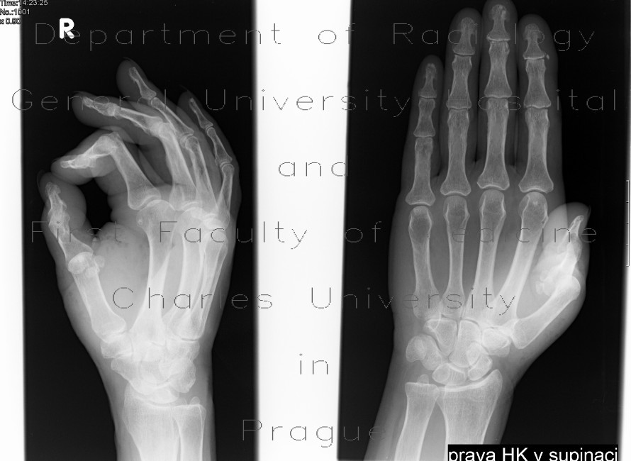 Dislocation of the first interphalangeal and metacarpophalangeal joint