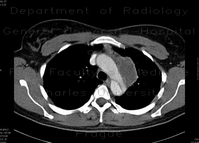 Dissecting aneurysm of the thoracic aorta