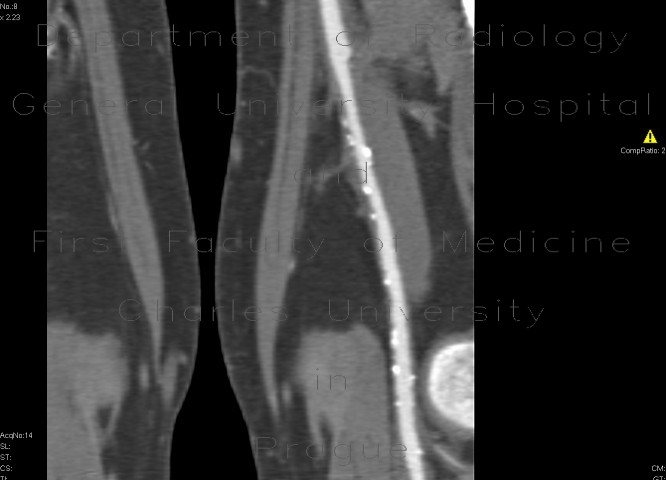 Distal anastomosis of femoro-popliteal bypass