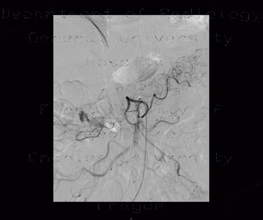 Radiology image - Diverticular bleeding, embolisation: Abdomen, Large bowel: AG - Angiography