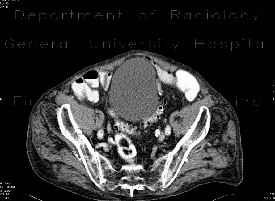 Diverticular disease of sigmoid colon