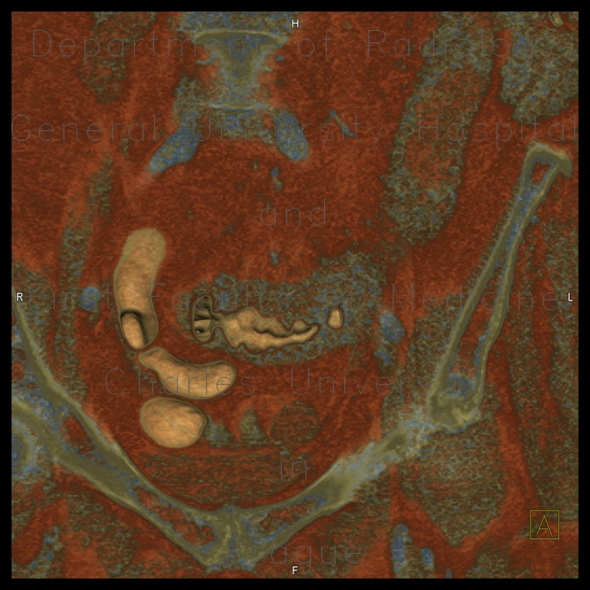 Radiology image - Diverticulitis of sigmoid colon, fistula, abscess, VRT: Abdomen, Large bowel, Peritoneal cavity: CT - Computed tomography