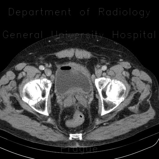 Diverticulitis, severe, colovesical fistula, fistula, vesicoureteral reflux