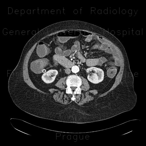 Diverticulosis, colonic diverticulum