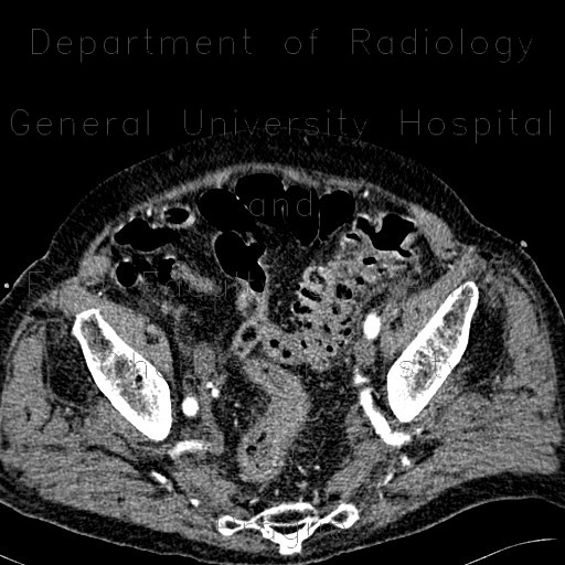 Diverticulosis of sigmoid colon