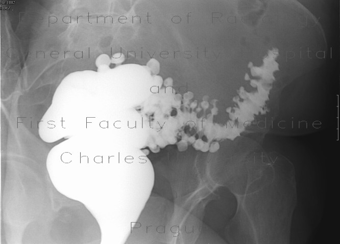 Diverticulosis of the colon