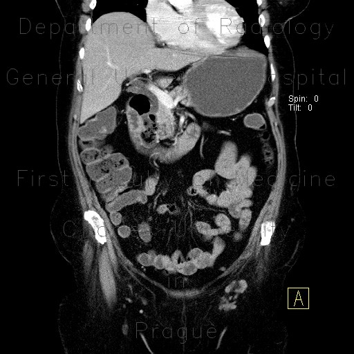 Radiology image - Diverticulum of duodenum: Abdomen, Small bowel: CT - Computed tomography